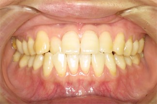 ホワイトニング施術後の歯の色