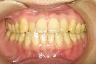 ホワイトニング施術前の歯の色