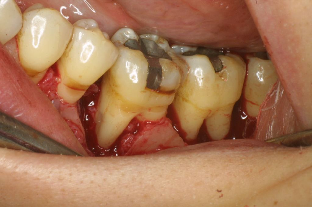 歯周病手術時