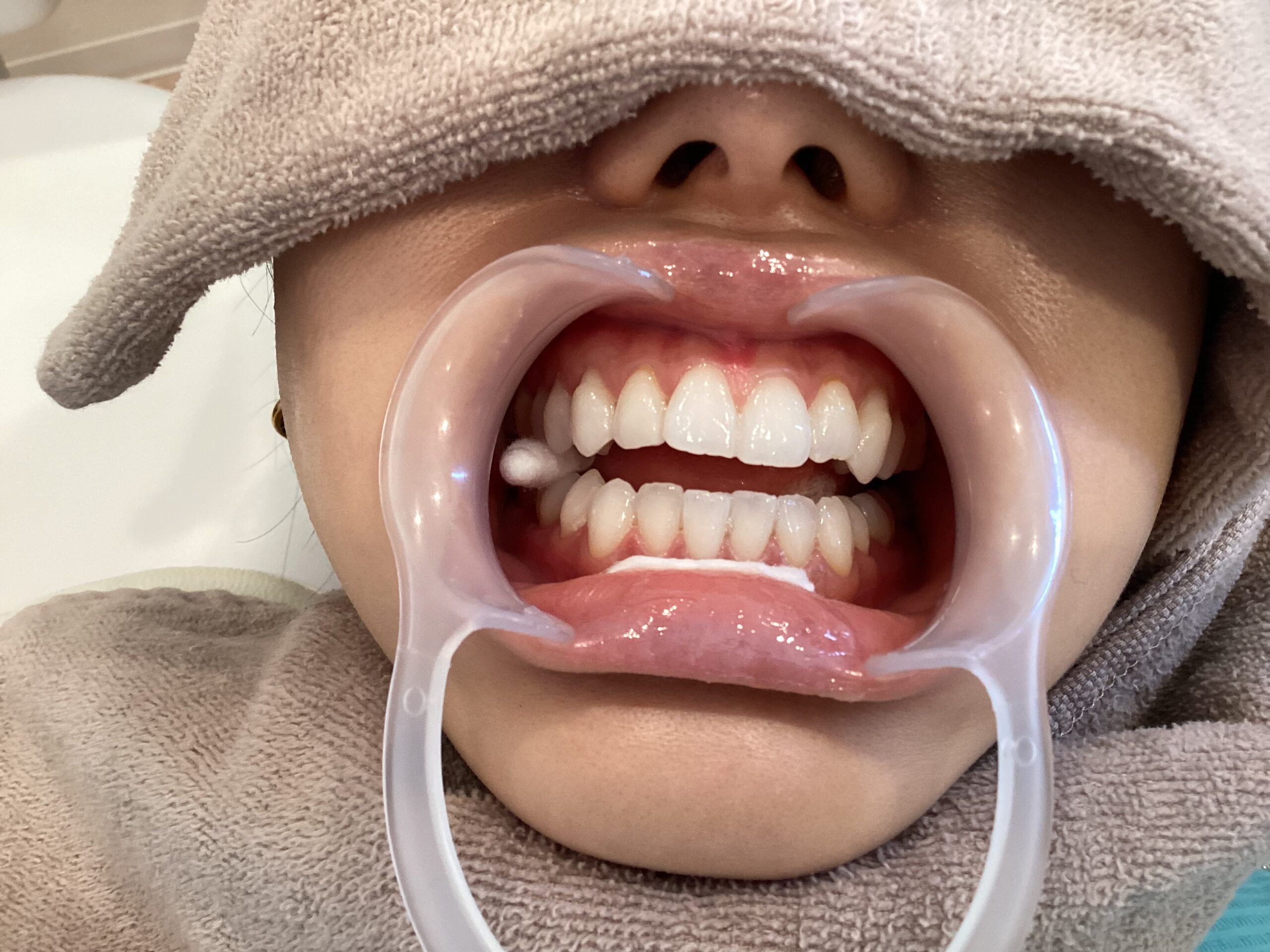 ホワイトエッセンス術後