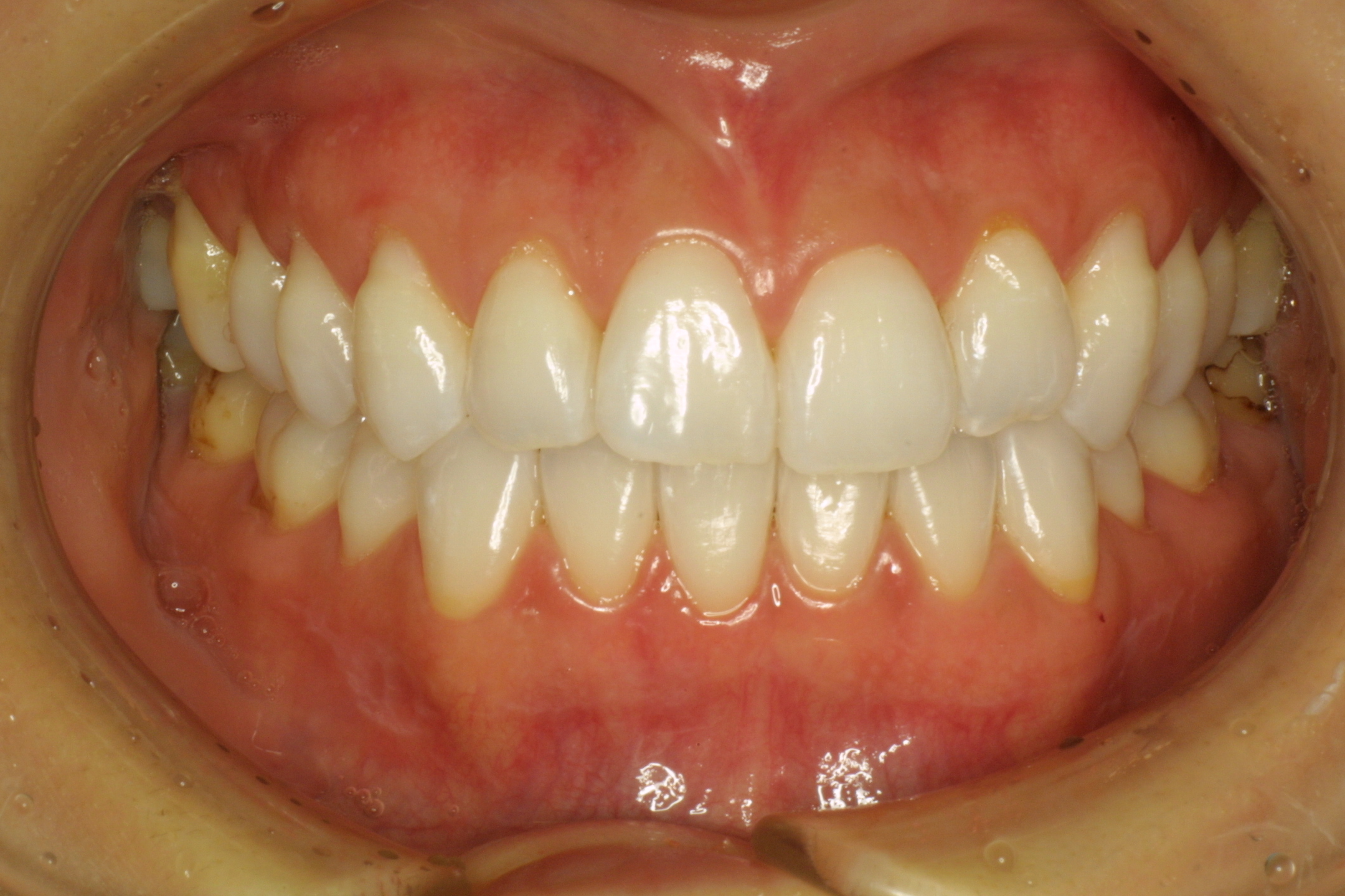 ホワイトエッセンス術後