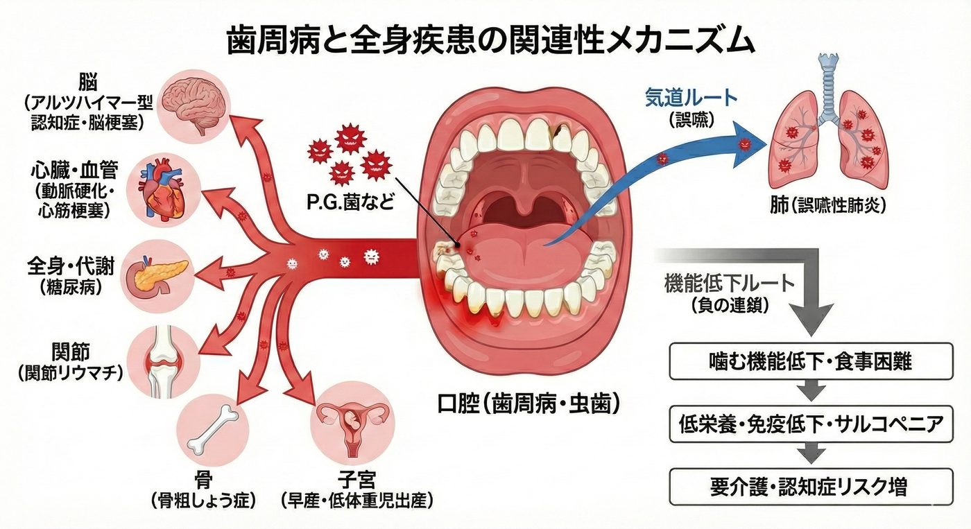 歯周病と全身疾患の関連性メカニズム。口腔から血流・気道・機能低下の各ルートで全身へ影響するイメージ図。
